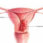 اسباب واعراض والوقايه من سرطان الرحم