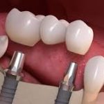 نصائح حول عملية زراعة الأسنان