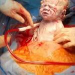 مخاطر الولادة القيصرية