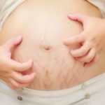 وصفات للتخلص من كلف الحمل