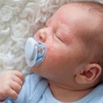 أعراض حساسية الألبان عند الرضع